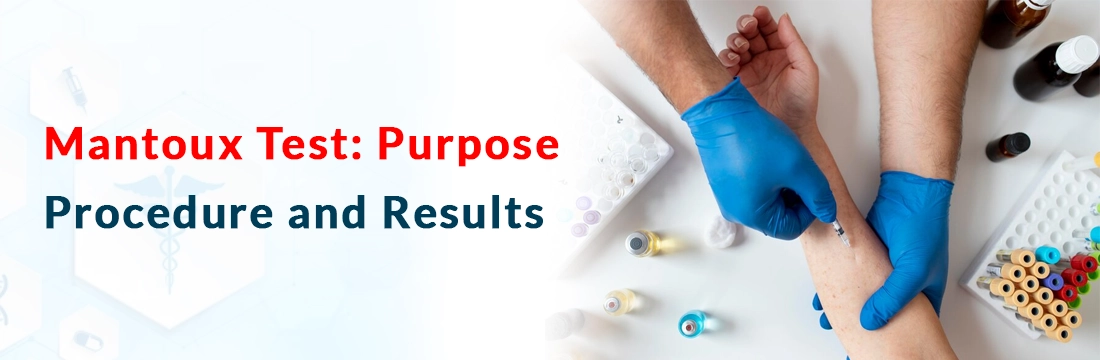  Mantoux Test: Purpose, Procedure and Results